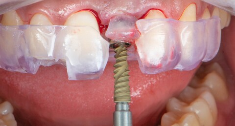 Einbringen des Implantats (Regio 21).